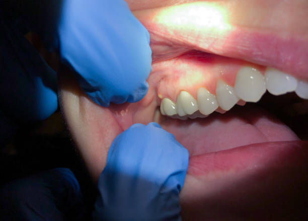Best Emergency Wisdom Tooth Extraction in Kempner, TX